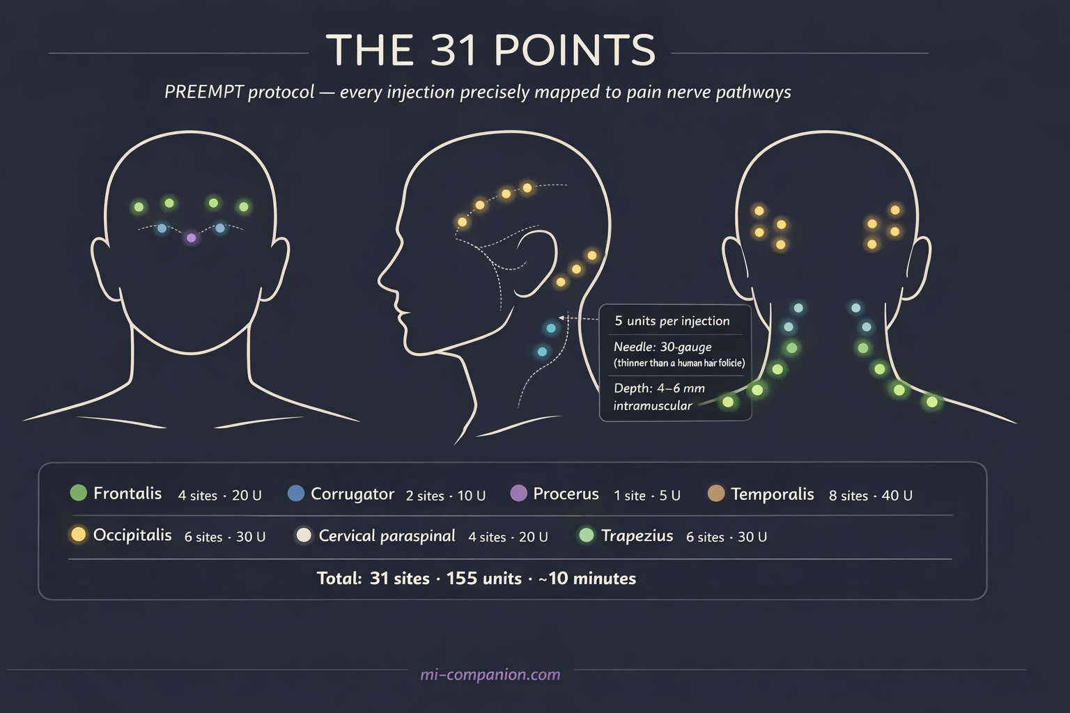 The 31 Points — PREEMPT protocol infographic showing front, side, and back views of the head with 31 color-coded injection sites across 7 muscle groups, with legend showing units per group