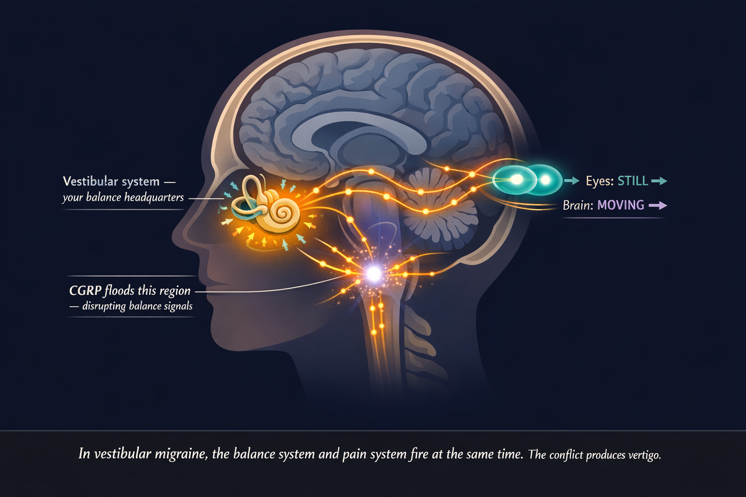 Scientific cross-section illustration of the human head showing the vestibular system in the inner ear, the vestibular nucleus in the brainstem flooded with CGRP, and the visual cortex in the occipital lobe showing conflicting signals &mdash; Eyes: STILL versus Brain: MOVING &mdash; with luminous amber nerve pathways connecting the three regions